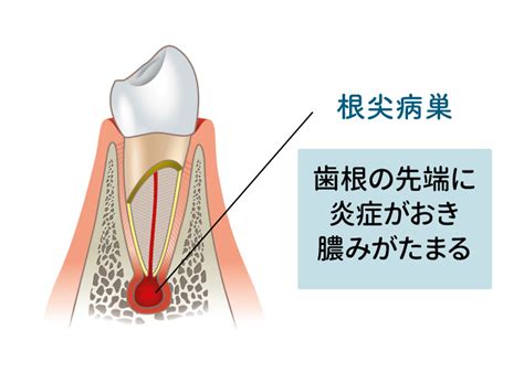 病巢 意味|病巣の読み方と意味、「びょうそう」と「びょうす」。